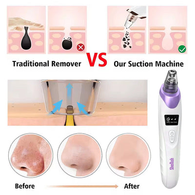 Vacuum Pore Cleaner - Remove Blackheads Without Irritation or Redness