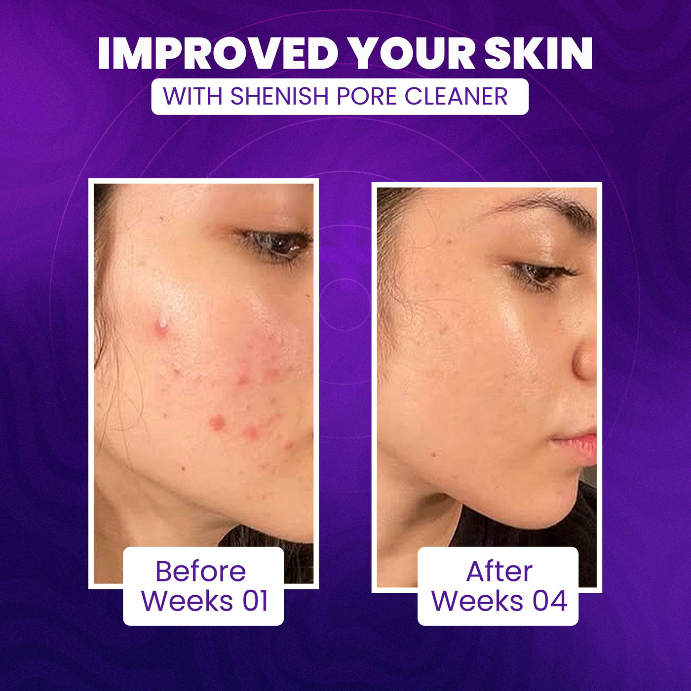 Vacuum Pore Cleaner - Remove Blackheads Without Irritation or Redness